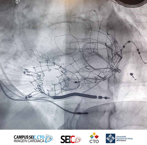 Máster en Procedimientos y Técnicas de Imagen en el Intervencionismo Estructural Cardíaco